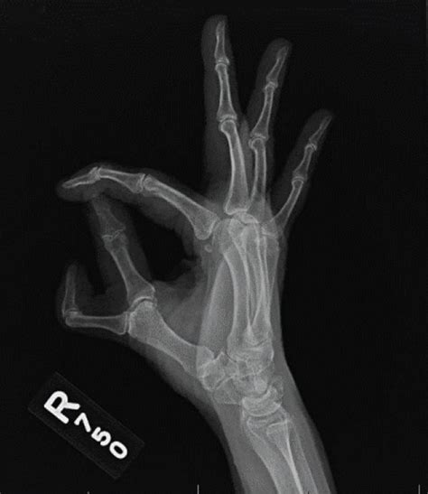 A 3 View X Ray Of The Right Hand Showed Preaxial Polydactyly A