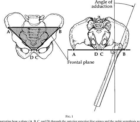 Figure 9 From The Effect Of Femoral Component Head Size On Posterior
