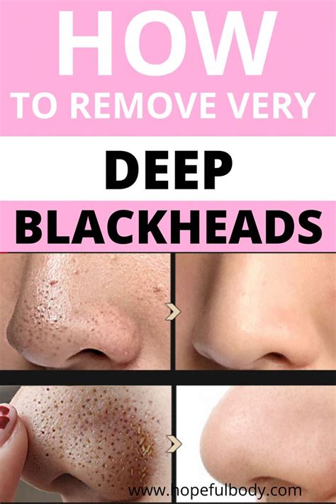 How To Remove Deep Blackheads The Ultimate Guide Ihsanpedia