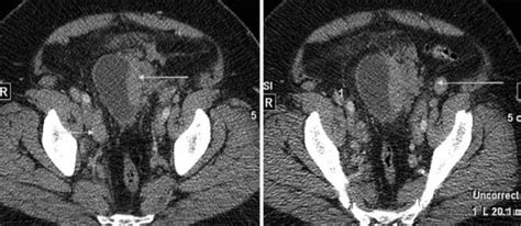 Contrast Enhanced Computed Tomography Scan Demonstrating Thickening Of