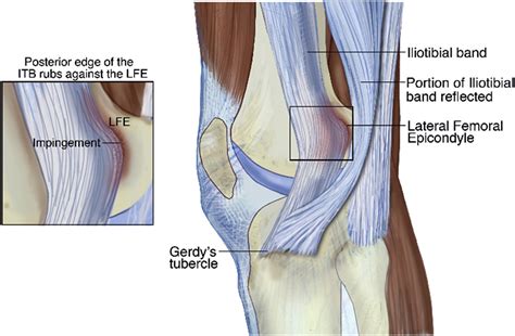 Iliotibial Band Syndrome In Runners Physical Medicine And