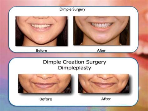 Dimpleplasty