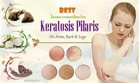 Keratosis pilaris signs and symptoms. 22 Best Home Remedies For Keratosis Pilaris On Arms, Back ...