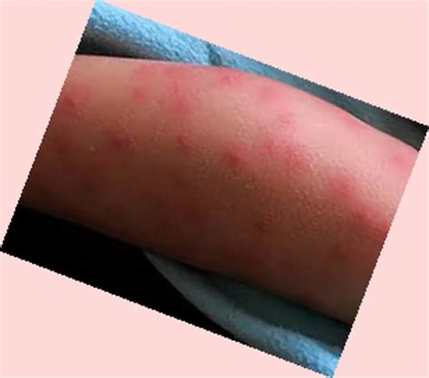 Bumps On Skin 4 Dorothee Padraig South West Skin Health Care