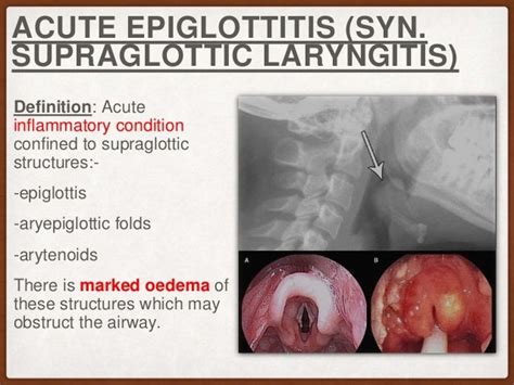 Acute Epiglottitiswhat To Know