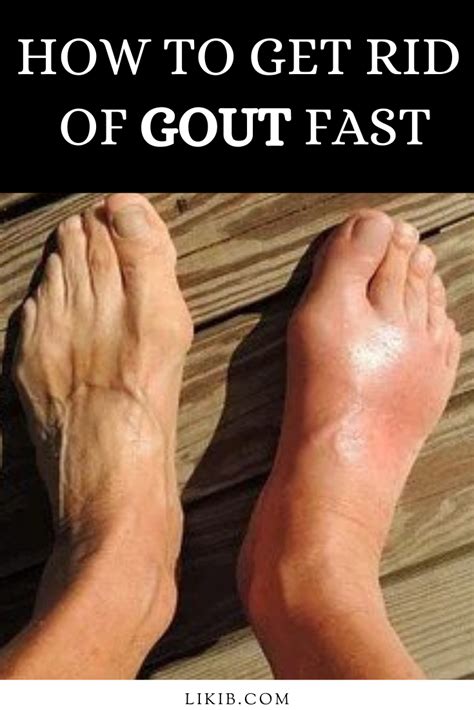 How To Get Rid Of Gout Fast Gout Remedies Gout Remedies