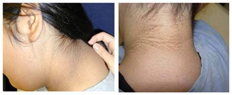 Acanthosis Nigricans Before And After