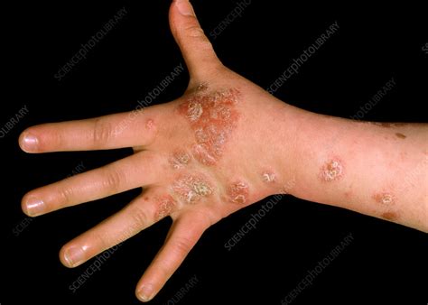 Psoriasis Of The Hand And Forearm Stock Image C0372753 Science