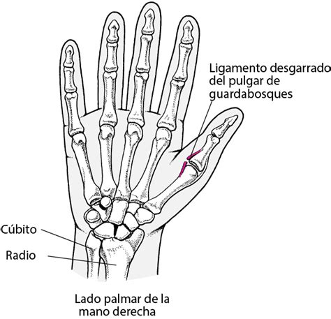 Esguinces Del Pulgar Traumatismos Y Envenenamientos Manual Msd