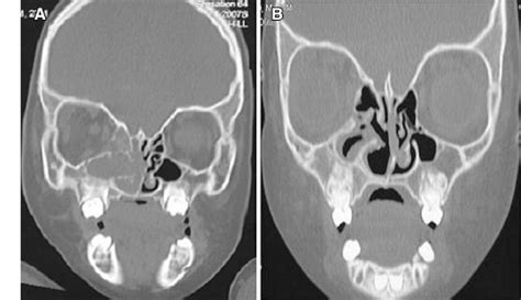 Coronal Computed Tomography Ct Scan Of The Paranasal Sinuses A