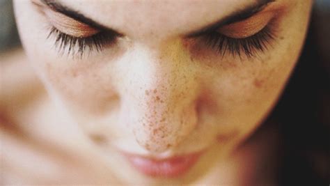Dark Spots On Skin Rash