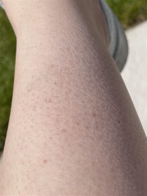 Why Are My Legs Scaly Nowhere Else On My Body Or Face Is Like This