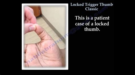 Locked Trigger Thumb Classic Everything You Need To Know Dr Nabil