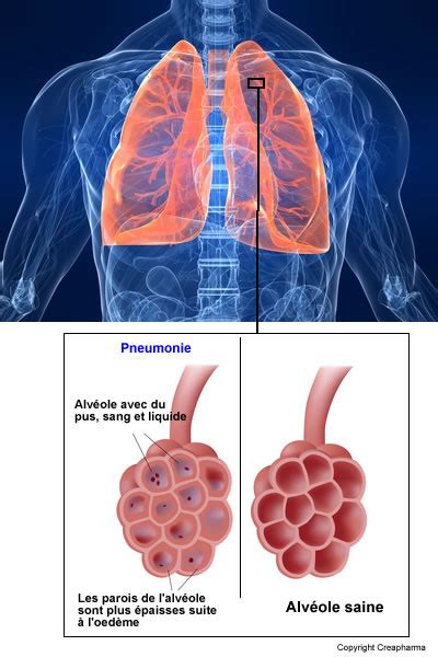 Pneumonie Causes Symptômes And Traitements Creapharma