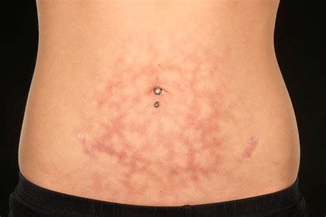 A Reticulated Eruption On The Lower Abdomen In A 17 Year Old Girl The Bmj