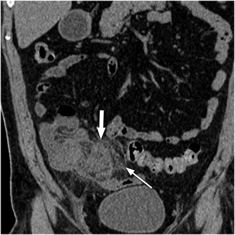 Comprehensive Review Of Typical And Atypical Pathology Of The Appendix