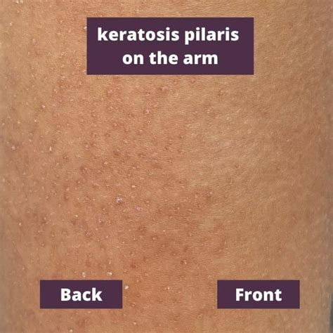 Treating Keratosis Pilaris The End Of Small Pimples In Oya