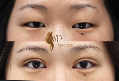 Asian Blepharoplasty Double Eyelid Surgery By Vip Plastic Surgery