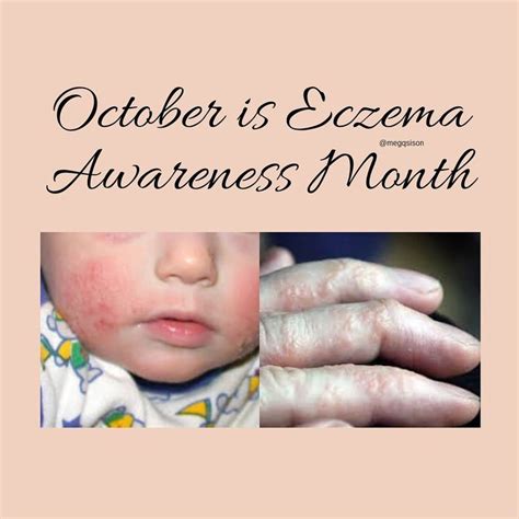 October Is Eczema Awareness Month Awareness Month Dermatology Awareness