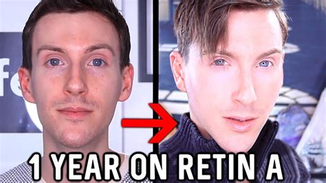 Apr 18, 2020 · because tretinoin will increase your sensitivity to the sun, it's important that you wear sunscreen! MY 1 YEAR RETIN-A RESULTS | BEFORE AND AFTER TRETINOIN ...