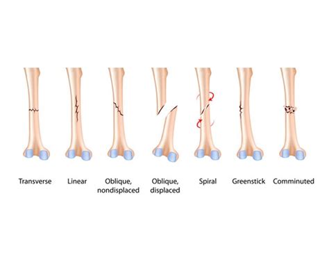 tibial shaft fracture causes types symptoms diagnosis
