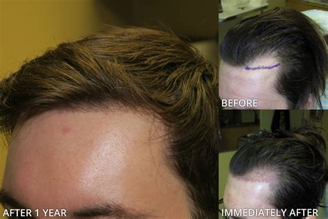 Before And After Picutres ARTAS Robotic Hair Transplant