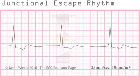 Ecg Educator Blog Junctional Rhythms