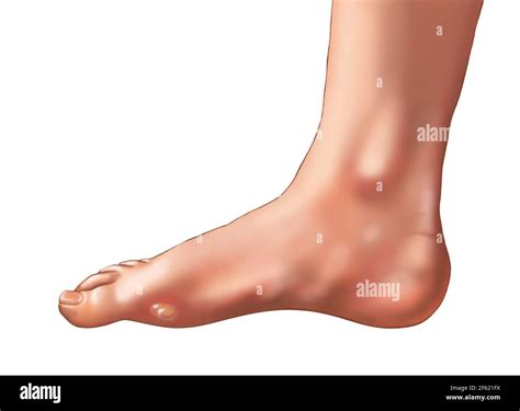 Blister On The Foot Stock Photo Alamy