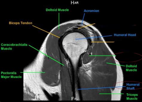 Shoulder Sagittal Oblique Mri 4 Diagram Quizlet