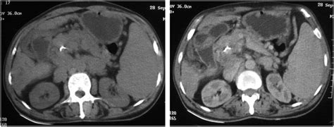 Plain And Contrast Ct Images Showing Heterogeneously Enhancing Lesion