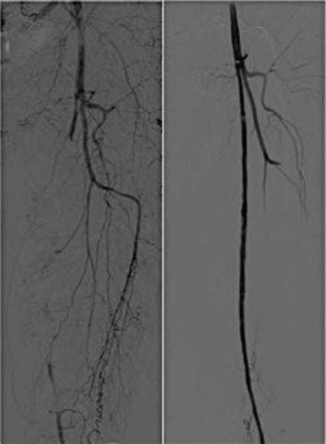Angiography Showing Acute Superficial Femoral Artery Sfa Thrombosis