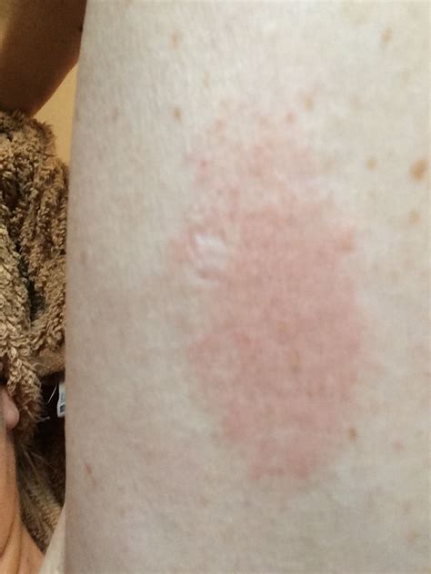 Image Gallery Lymphoma Rash Itching Riset