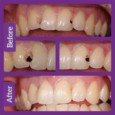 Composite Bonding Fareham Crofton Dental Care