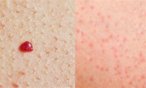 What Do Red Spots On Skin Mean 13 Skin Spots And Bumps Pictures Scoopsky