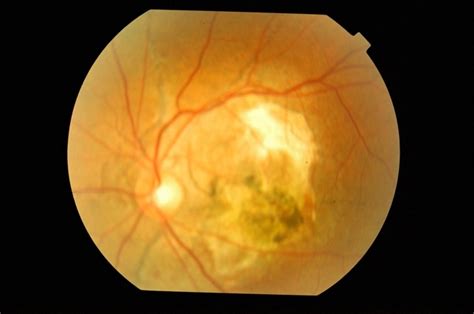 Bilateral Angioid Streaks With Cnvm Retina Image Bank