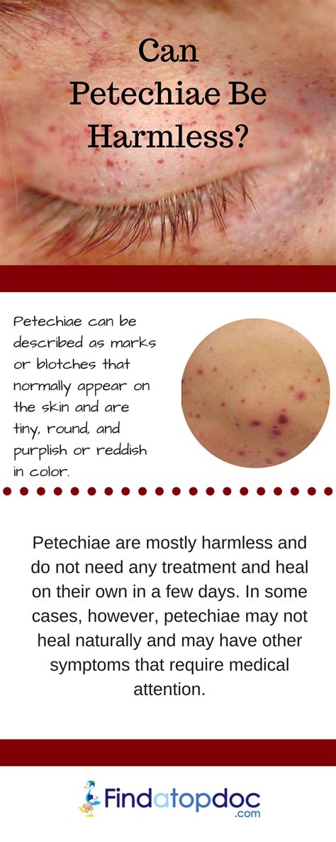 Petechiae Causes