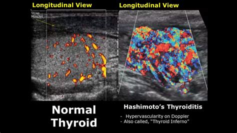 Dr Sams Imaging Library Thyroid Ultrasound Normal Vs Abnormal Image