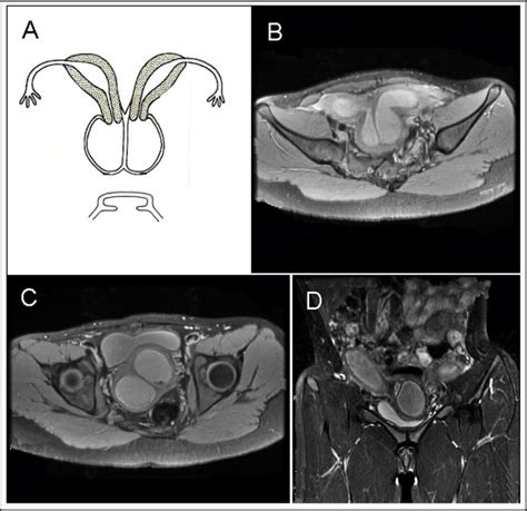 Uterine Didelphys With Duplicated Upper Vagina And Bilateral Lower