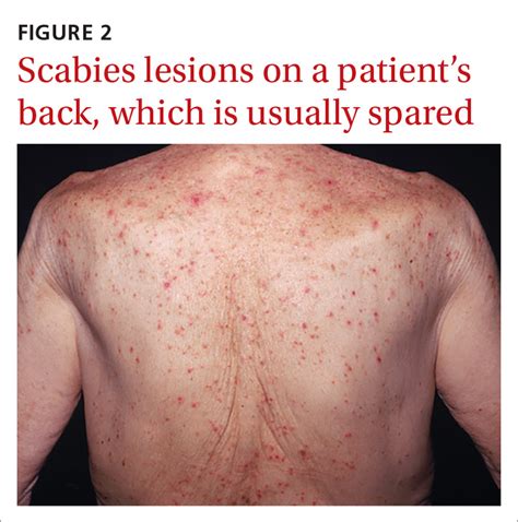 Scabies Causes Pictures Prevention And Treatment