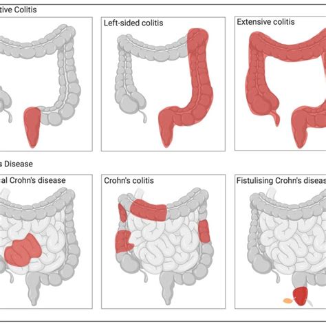 Different Types Of Inflammatory Bowel Diseases A Ulcerative Colitis