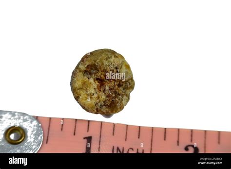 Large Gallstone Removed Surgically After Laparoscopic Cholecystectomy