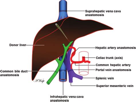 Liver Transplant Diagram