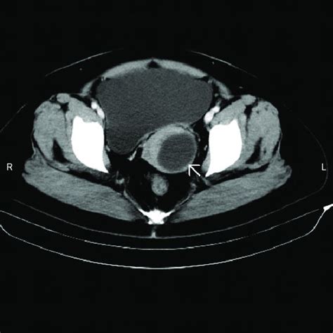 Pdf A Large Nabothian Cyst Causing Chronic Urinary Retention A Case