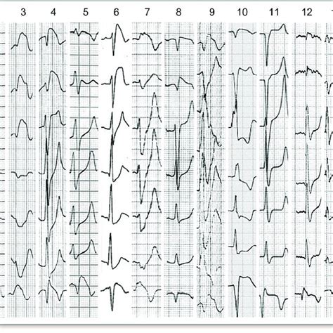 Ecg Stemi Ecg Showing An Anterolateral Stemi In A 68 Year Old Man With