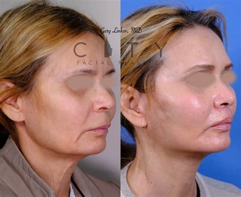 Nyc Neck Lift Surgery New York Lower Rhytidectomy Ues