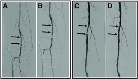 Digital Subtraction Angiography In A Patient With Cli Undergoing