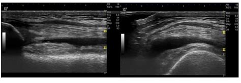 Ultrasonography Guided Injections For Knee Osteoarthritis In Primary