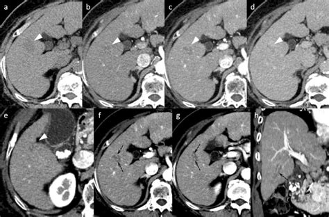 Liver Nodules On Ct Scan