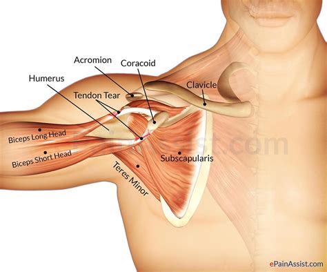 External rotation, weak adductor of the humerus, stabilizes the shoulder joint, holds the head of the tendon of the muscle fuses with the articular capsule of the humerus before inserting on the. Pin on torn shoulder tendon