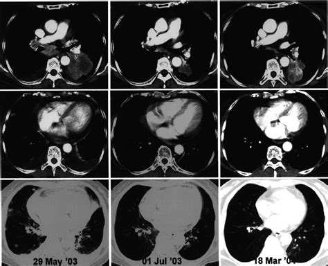 Chest Ct Scan Shows That All The Primary Tumor And Enlarged Lymph Nodes